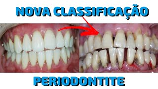 A nova Classificação 2017 de Periodontite DESCOMPLICADA [upl. by Mills]