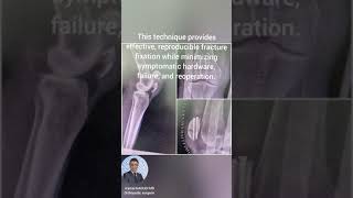 osteosynthese réparation dune fracture de rotule genou rééducation précoce appui immédiat [upl. by Senoj]