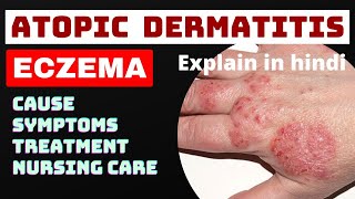 Tinea Versicolar Treatment  भभूतीसीपसहुआकरोडिया का इलाज  Pityriasis Versicolor  In Hindi [upl. by Dahij]