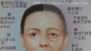 続・眼瞼下垂・瞼くぼみに対する拡大埋没法 suture method for blepharoptosis amp sunken eyes Continued [upl. by Tail280]