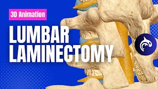 Lumbar Laminectomy  3D Animation [upl. by Ailenroc]