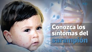 Conozca los síntomas del sarampión  Prensa Libre [upl. by Alhahs]