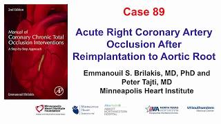 Case 89 Manual of CTO Interventions Acute occlusion of reimplanted RCA [upl. by Leblanc854]