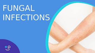 Fungal Infections  Causes Prevention and Cure [upl. by Aicnarf]