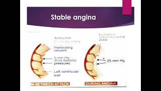 PATHOPHYSIOLOGY OF ANGINA [upl. by Ttelracs]