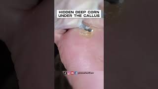 HIDDEN DEEP CORN UNDER THE CALLUS ON BOTTOM OF FOOT TREATMENT BY FAMOUS PODIATRIST MISS FOOT FIXER [upl. by Llerrehc343]