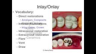 Introduction to inlaysonlays [upl. by Narat]