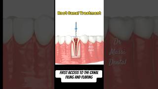 Root Canal Obturation [upl. by Morrell]