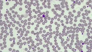 WBC Differential WBCPLT Estimate RBC Morphology [upl. by Phipps873]