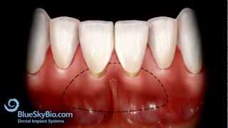 Patient Treatment Videos Free Gingival Graft [upl. by Musette769]