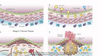 Stages of Atherosclerosis [upl. by Airam255]