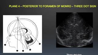 TMT Neurosono by Dr Mrudula Bapat  Basic Anatomy amp Scanning Technique [upl. by Abih]