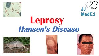 Leprosy Hansens disease  Who is at risk Signs and Symptoms Diagnosis and Treatment [upl. by Gainor]