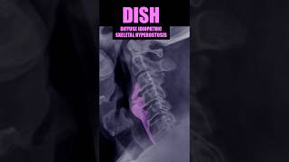 DISH  Diffuse Idiopathic Skeletal Hyperostosis xray cervical bones [upl. by Artened]