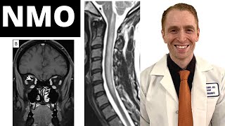 Neuromyelitis Optica NMO Symptoms Diagnosis MRI Findings Treatment Clinical Trial Results [upl. by Jumbala]