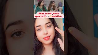 Acne scars acnescars acne acneremoval acnetreatment shorts beautytips skincare pimple short [upl. by Anuahsed229]