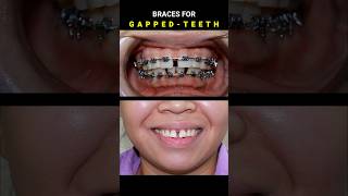 BRACES FOR GAPPED TEETH 32 MONTHS DURATION braces orthodontist dentist [upl. by Robbyn]