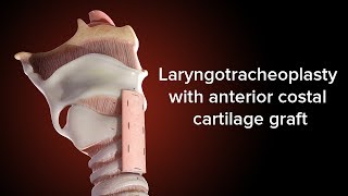 Medical Animation Anterior Cricoid Split  Cincinnati Childrens [upl. by Arianne548]