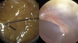 149  Type 2 Ear Wax Removal Based on Rai Modified ‘Bristol’ Cerumen Chart using WAXscope®️ [upl. by Markos]