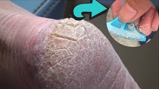 RAZOR FOR CRACKED HEELS  Live Callus Removal [upl. by Olympia]