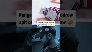 He took a puck to the face and lost part of his jaw 😬 [upl. by Angrist830]