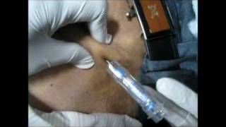 How To Give Goserelin Injection By Subcutaneous Mode [upl. by Eseerahs998]