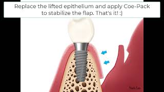 Modified Edlan Mejchar Technique  Simple solution for Shallow vestibule amp No attached gingiva [upl. by Arlan172]