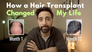 How Two Hair Transplants Changed My Life [upl. by Lucio892]