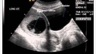 2 month ultrasound  wide view [upl. by Alliehs]