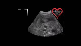 Pyloric Stenosis Ultrasound [upl. by Alol]