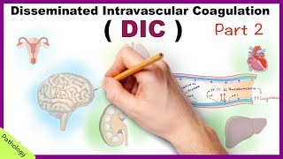 DIC Disseminated Intravascular Coagulation  Part 2 [upl. by Nevram]