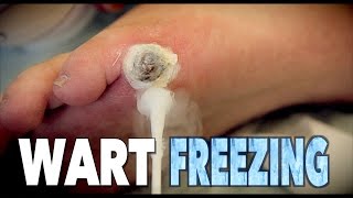 GIANT WART FREEZING with liquid nitrogen  Dr Paul [upl. by Eerej181]