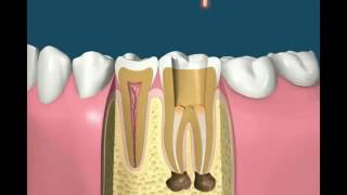 Root canal treatment animation [upl. by Anerat142]