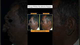 SturgeWeber Syndrome Surgery at GSR [upl. by Auvil]