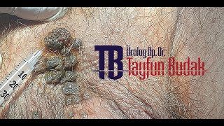 Kondilom  Genital Siğil  KoterizasyonuOP DR TAYFUN BUDAK [upl. by Threlkeld]