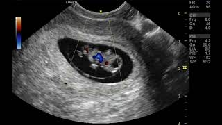 Sonography of the amniotic membrane and yolk sac in early pregnancy and significance [upl. by Chevy934]