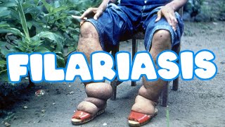 Filariasis  Elephantiasis  wuchereria bancrofti  Life cycle  clinical features  Lab diagnosis [upl. by Elockcin]