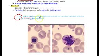 Sideroblastic AnemiaMicrocytic Anemia [upl. by Eckmann751]