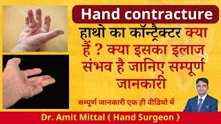 Hand Contracture क्या हैं क्या इसका इलाज संभव है जानिए सम्पूर्ण जानकारी  Hand Contracture in hindi [upl. by Nnylidnarb]