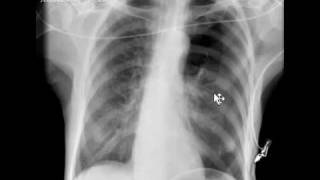 Chest xray pneumothorax [upl. by Vassaux]