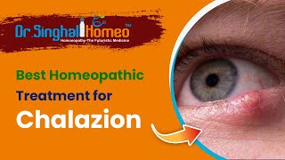 Best Homeopathic Treatment for Chalazion  Dr Singhal Homeo [upl. by Nirel]