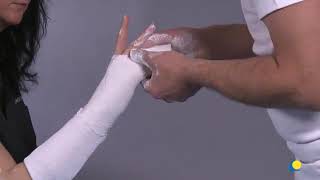 Dorsopalmer ulnar gutter short arm splintslab using plaster of paris [upl. by Liborio]