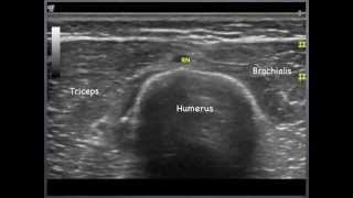 Radial Nerve  humerus to elbow Sonoanatomy  QMH AED Ultrasound Casebook 2013 Video 7 [upl. by Stahl]