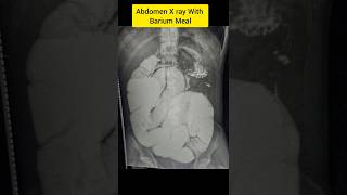 Abdomen X ray with Barium Meal [upl. by Niwrud]