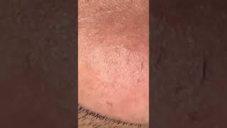 relaxing satisfying plucking tweezer extraction hair ingrownhair ingrown pluck follicle [upl. by Etnoled413]