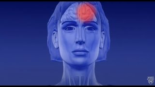 Learn About Migraine Aura [upl. by Atsirk]