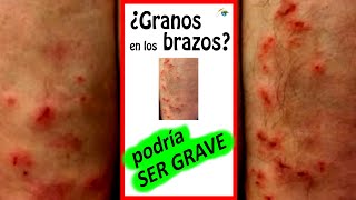 💥 GRANOS en los BRAZOS que PICAN 💥 Ampollas 💥 PICOR en la PIEL Dermatitis Herpetiforme FOTOS Shorts [upl. by Imrots]