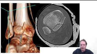 case takeaway  posterior malleolus type 2B ankle fracture management  Lyndon Mason [upl. by Truman]