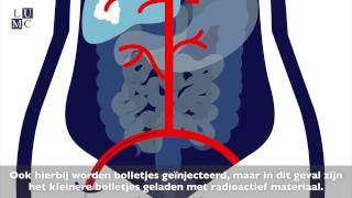 Tace en Radioembolisatie met Nederlandse Ondertitel [upl. by Atthia]