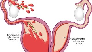 vaginafallopian tube wollfianductmullarianductvaginalseptumtransevrseseptum [upl. by Llemor]